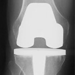 Knee Joint Replacement